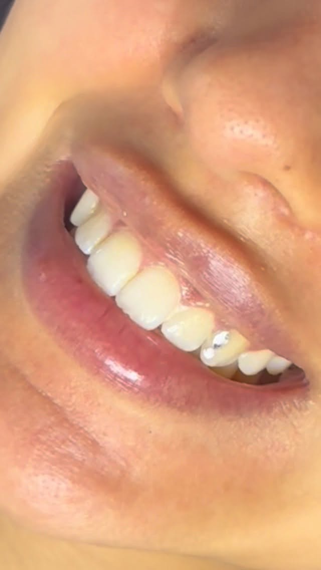 Tooth gems